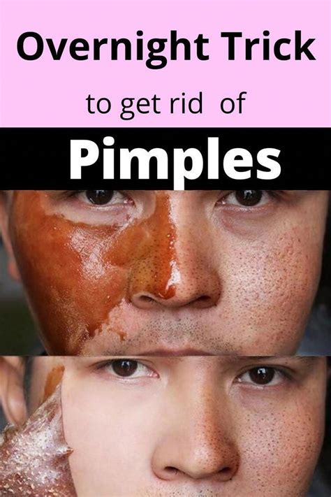 7 Home remedies to get rid of pimples fast .